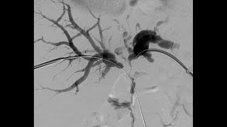 Percutaneous Transhepatic Cholangiography and Drainage PTCD [upl. by Renata733]