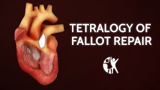 Tetralogy of Fallot Treatment Options [upl. by Zina493]