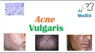 Acne Vulgaris  Causes Pathogenesis Influencing Factors Diagnosis Treatment and Complications [upl. by Kosey]