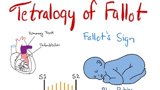 Tetralogy of Fallot TOF  Part 1  Components amp Murmur Explained  Dr Saykat [upl. by Esnohpla]