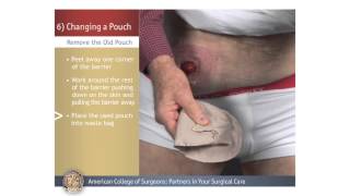 ColostomyIleostomy Changing a Pouch [upl. by Airol904]