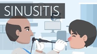 What is Sinusitis [upl. by Ayahsal]