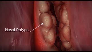 Do polyps stop you getting pregnant amp its management  Dr Rashmi Yogish [upl. by Arbmat]