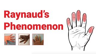 Raynaud’s Phenomenon  What You Should Know  Johns Hopkins Medicine [upl. by Aelahc926]