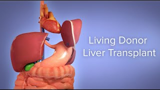 Medical Animation Living Donor Liver Transplant  Cincinnati Childrens [upl. by Adnaram504]