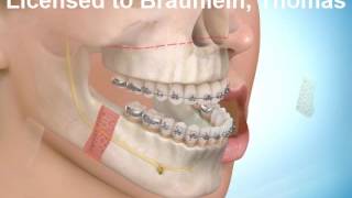 Oberkiefer Vorverlagerung und Unterkiefer Rückverlagerung [upl. by Gilchrist15]