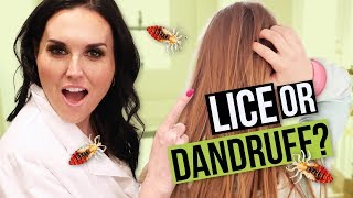 Dandruff or Head Lice How to tell the Difference [upl. by Mahseh]