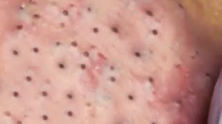 How To Remove Blackheads And Whiteheads On Face Easy 97 ✦ Dr Laelia ✦ [upl. by Olnee783]