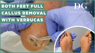 Callus removal from feet both feet and three verruca plantar warts treatment [upl. by Aubarta]