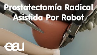 Prostatectomía Radical Asistida Por Robot [upl. by Eiramyelhsa331]