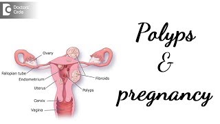 Nasal Polyps  Treat Nasal Polyps Without Surgery [upl. by Ihcur725]