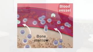 Dr Jain on GVHD From Allogeneic Stem Cell Transplant [upl. by Subocaj247]