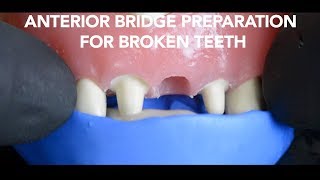 Dental Bridge Preparation after Tooth Extraction [upl. by Nameerf]