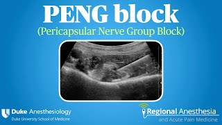 PENG Block Pericapsular Nerve Group Block [upl. by Tabib430]