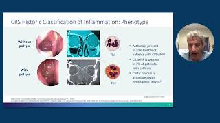 Rhinosinusitis With Nasal Polyps From Pathophysiology to Management [upl. by Esiuol448]