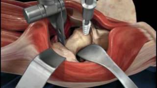 Direct Anterior Approach Hip Replacement [upl. by Bald]