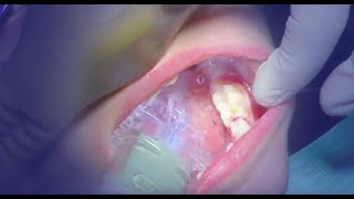 Isolite Systems and Pediatric Dentistry [upl. by Lered498]