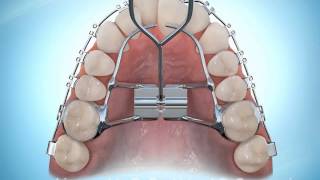 Hyrax Rapid Palatal Expansion Braces During [upl. by Gavrilla]