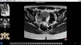 Female Pelvis MRI [upl. by Leugar]