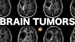 Brain Tumors [upl. by Elise]