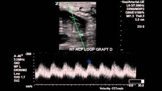 Av Fistula Cannulation Training Fun And Easy [upl. by Florri]