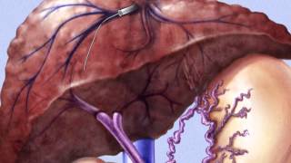 TIPSS Transjugular Intrahepatic PortoSystemic Shunt [upl. by Enorej]