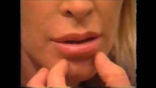 Dr Randal Haworth  Lip Enhancement via VY Plasty [upl. by Brine]