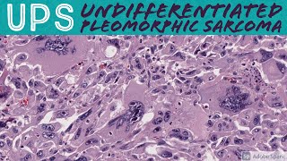 Undifferentiated Pleomorphic Sarcoma 101 UPS formerly malignant fibrous histiocytomaMFH [upl. by Halda]