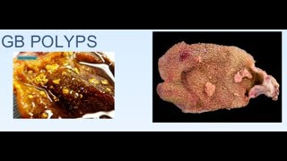 Nasal Polyps diagnosis and treatment options [upl. by Raymond]