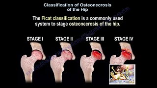 Osteonecrosis Of The Hip Ficat Classification  Everything You Need To Know  Dr Nabil Ebraheim [upl. by Hbahsur]