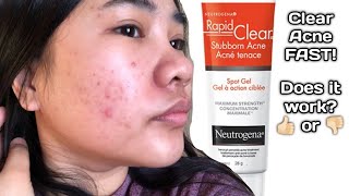 Neutrogena Rapid Clear Stubborn Acne Spot Gel Does it work [upl. by Leirea]