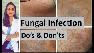 Fungal infection of skin  Dos and Donts  Dermatologist  Dr Aanchal Panth [upl. by Karry]