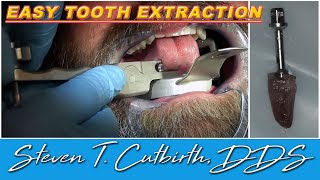 Easy Tooth Extraction  Dental Minute with Steven T Cutbirth DDS [upl. by Ozzy]