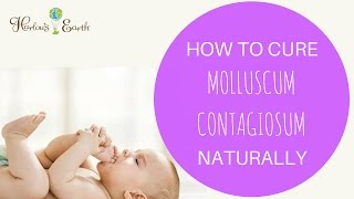 How To Cure Molluscum Contagiosum Naturally [upl. by Zwart]