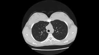 Normal Chest CT  using quotlung windowsquot [upl. by Halik]