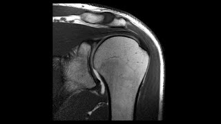 PROTOCOLO RESONANCIA MAGNETICA DE HOMBRO [upl. by Enrobso]