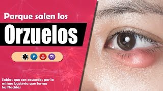 POR QUE SALEN LOS ORZUELOS EN LOS OJOS  Perillas en los ojos [upl. by Anirbas976]