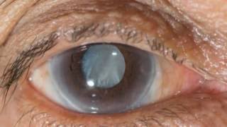 New eye drops may help treat cataracts [upl. by Estey]