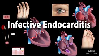 Infective Endocarditis Animation [upl. by Evette384]