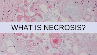 What is Necrosis  Pathology mini tutorial [upl. by Margalo]