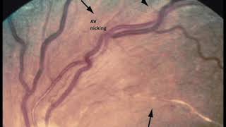 Thrombectomy of dialysis AVG [upl. by Enahc]