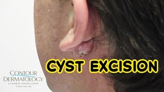 Stubborn Reoccurring Cyst Needs Removal [upl. by Kalli]