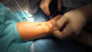 Percutaneous Achilles Tendon Surgery Repair Unedited by Kevin R Stone MD [upl. by Etnomal]