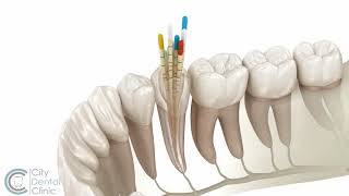 Endodontics  Root canal treatment  City Dental Clinic Bratislava [upl. by Piero872]