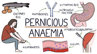 Understanding Pernicious Anaemia B12 Deficiency [upl. by Acinahs113]