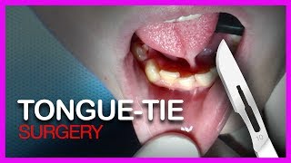 Tongue Tie SURGERY [upl. by Armil892]