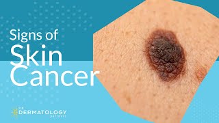 Skin Cancer Screening  Symptoms Types amp Warning Signs [upl. by Daveta]