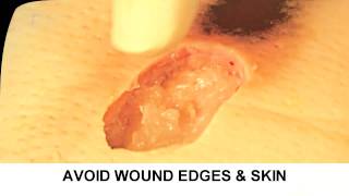 Enzymatic Debridement Demonstration Understand Wound Care [upl. by Monson]