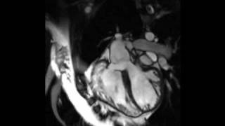 Cardiac MRI  Tetralogy of Fallot [upl. by Merlin185]