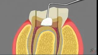 pulpotomy [upl. by Electra166]